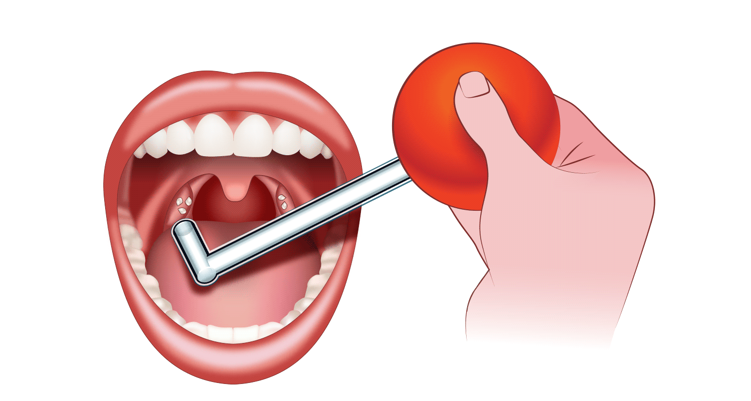 removing tonsil stones