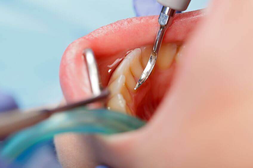 remove dental plaque