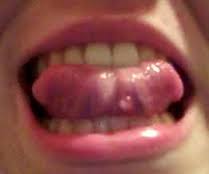 sores on tongue