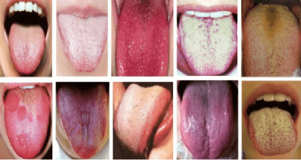causes white tongue coating