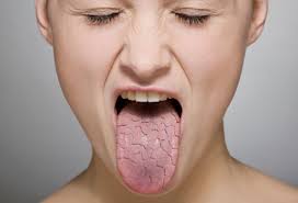 white tongue due to dry mouth