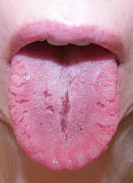 tongue diseases