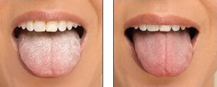 causes of white tongue