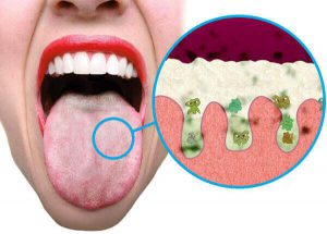 white tongue and bad breath