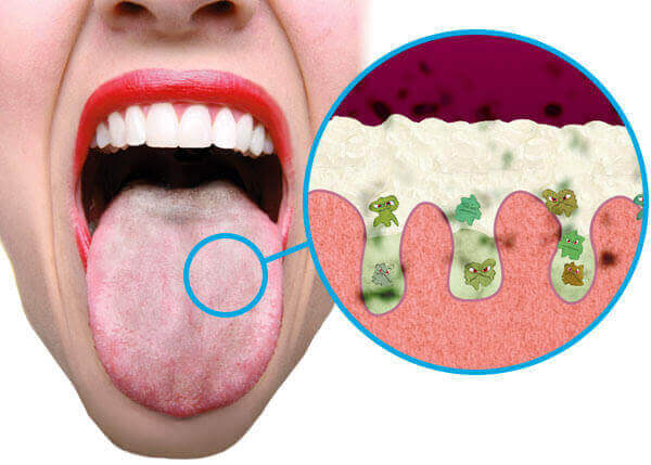 white tongue coating