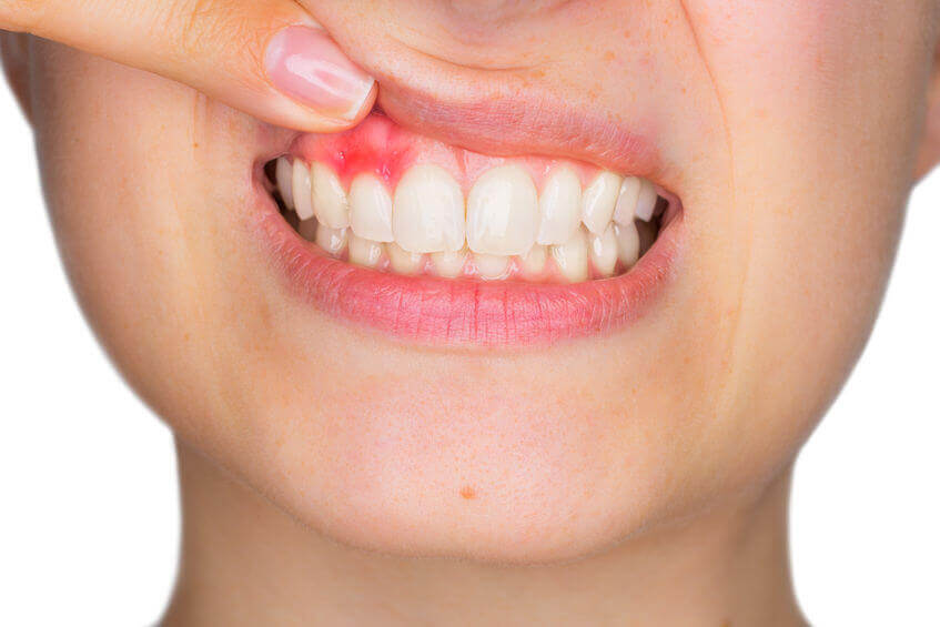 causes receding gums