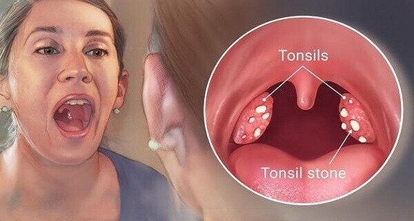 bad breath due to tonsil stones
